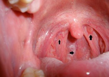 Ung thư vòm họng mềm là gì? Những nguyên nhân gây nên bệnh