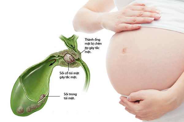 Viêm túi mật cấp tính trong thai kỳ