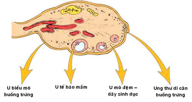 Các triệu chứng của u tế bào mô đệm buồng trứng là gì?
